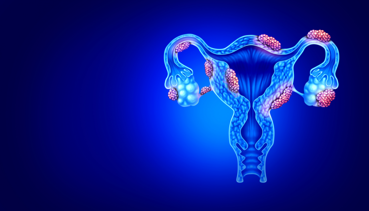 Endometriose