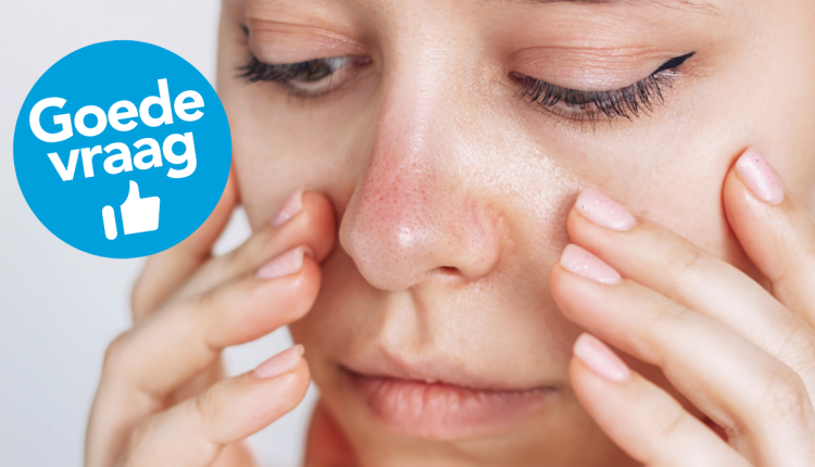 vrouw met rosacea