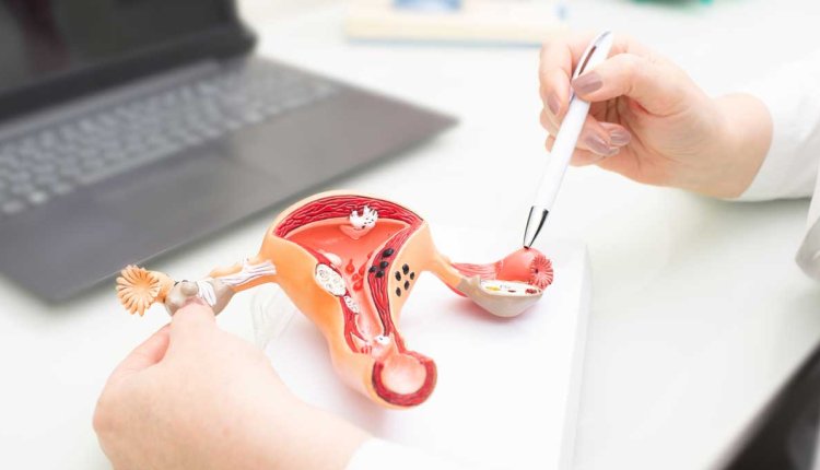 endometriose