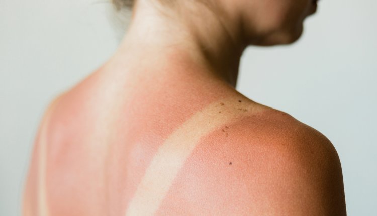 aftersun bij verbrande huid