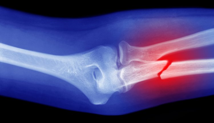 rontgenfoto van gebroken arm