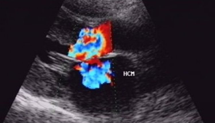 Echografie hart