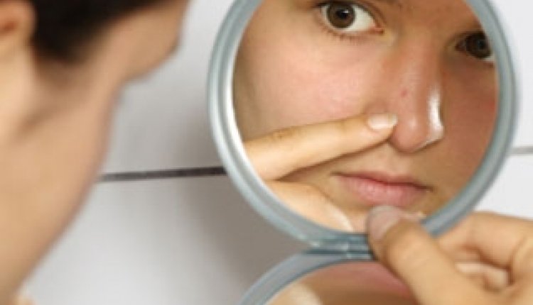 Acne jeugdpuistjes