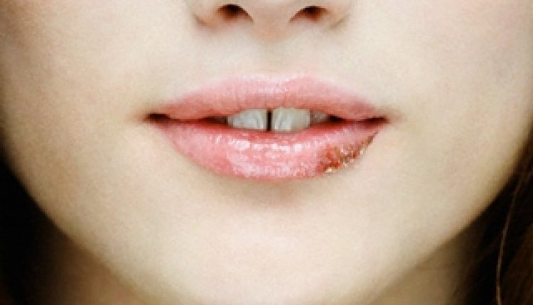 Herpesvirus