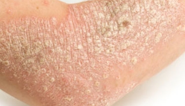 Psoriasis arm