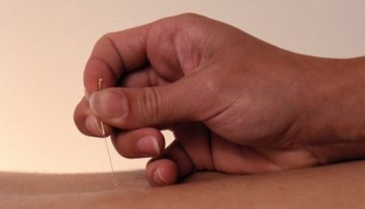 Acupunctuur