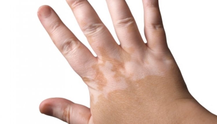 Vitiligo