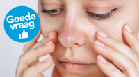 vrouw met rosacea