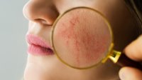 vrouw met rosacea