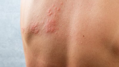 Wat is gordelroos? Alles wat je moet weten over dit virus