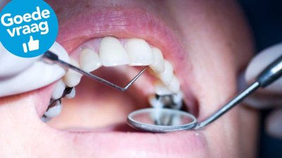 Zijn grijze amalgaamvullingen schadelijk voor je gezondheid?
