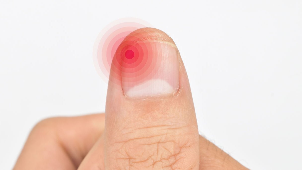 Ontstoken nagelriem: hoe kom je ervan af? | Gezondheidsnet