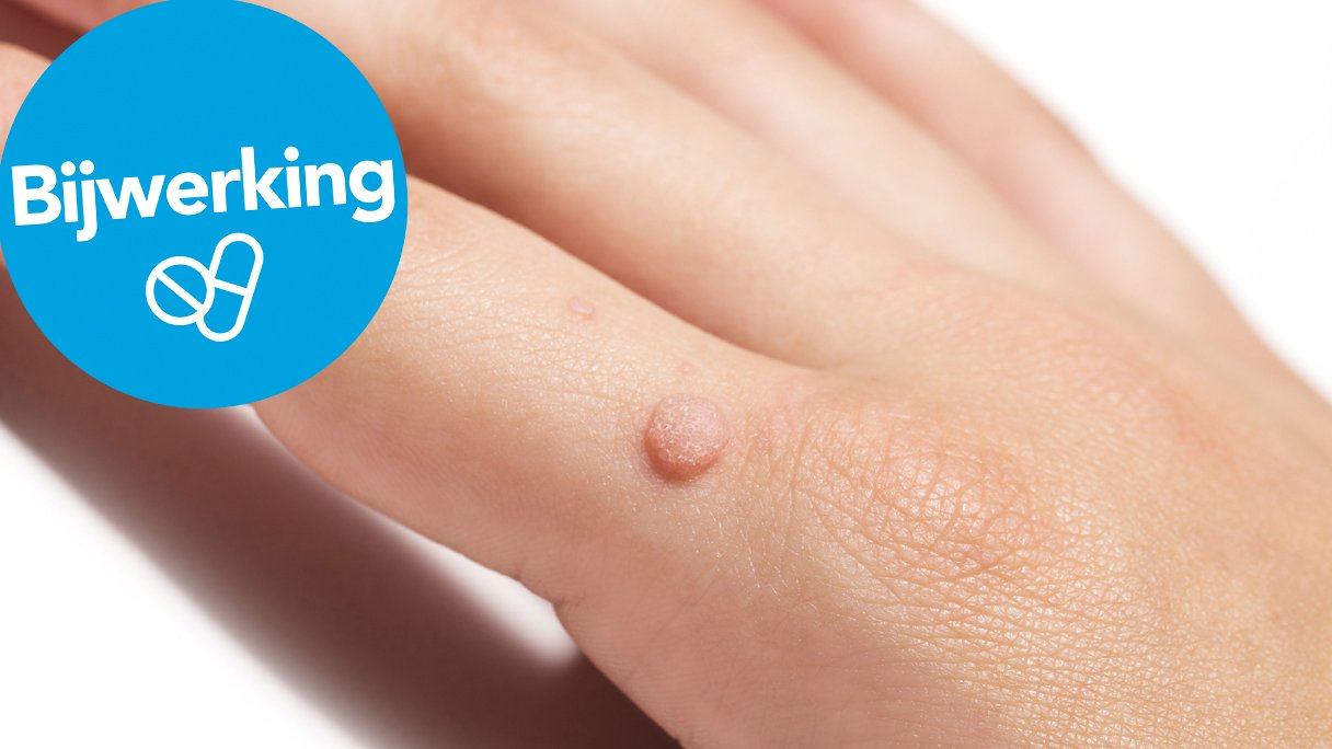 Last van wratten? Misschien komt het wel door je medicijn | Gezondheidsnet