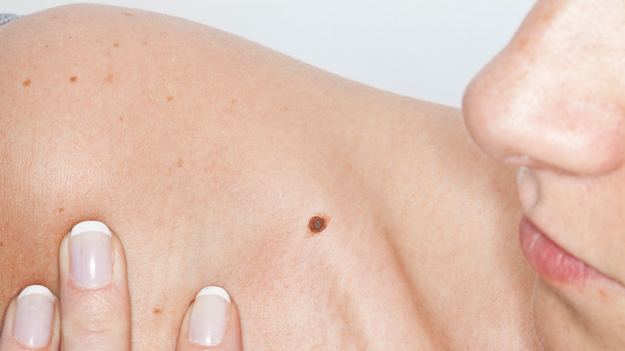 14 Vragen Over Melanoomkanker | Gezondheidsnet