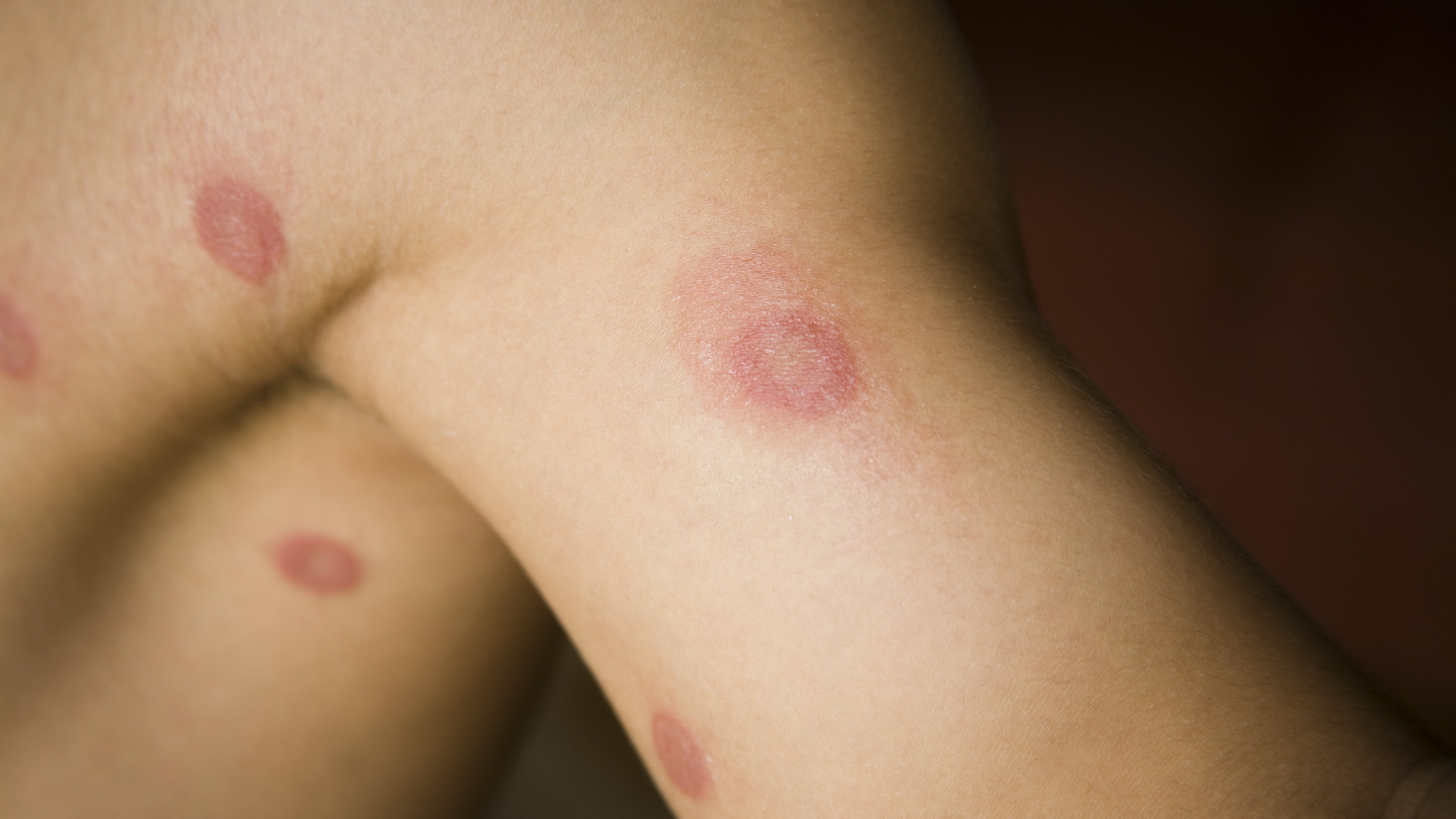 zuurgraad knelpunt Ijver Ringworm, een vervelende huidinfectie | Gezondheidsnet