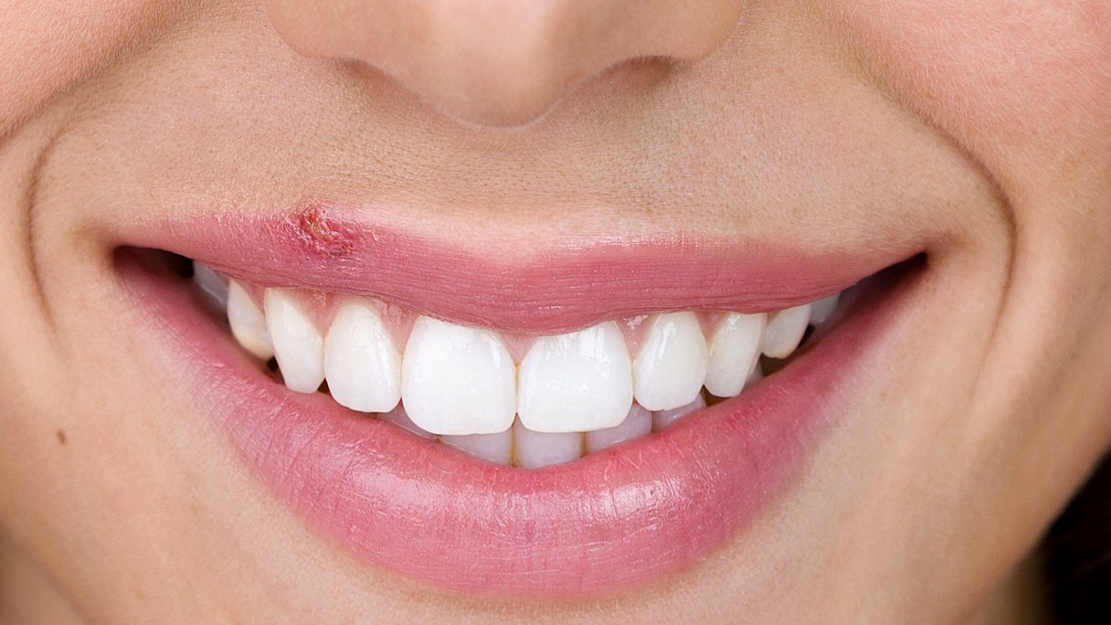 Een koortslip: wat is het en hoe komt het? | Gezondheidsnet