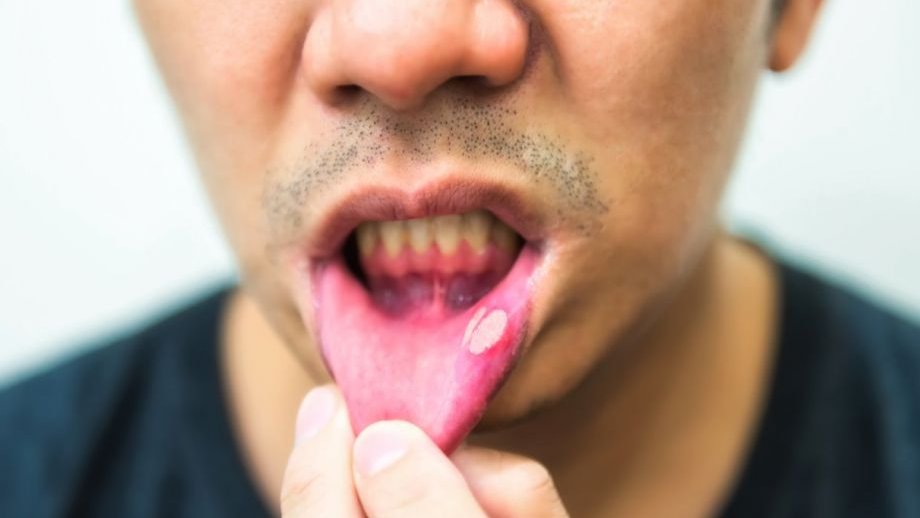 Aften in je mond? Vervelend, maar