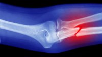 rontgenfoto van gebroken arm