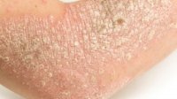 Psoriasis arm