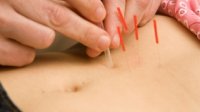Acupunctuur buik vrouw