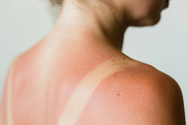 aftersun bij verbrande huid